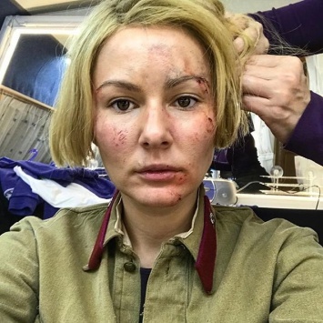 В Instagram появилось фото Кожевниковой с синяками на лице