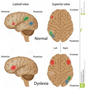 Ученые: людям с дислексией труднее научиться читать и писать