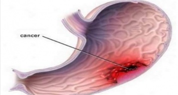 Рак желудка: тихий убийца - наиболее распространенные симптомы (не игнорируйте их)