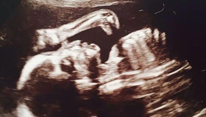 Будущая мать обнаружила динозавра на внутриутробном снимке эмбриона
