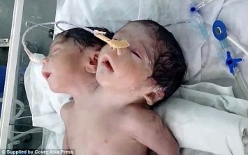 Новорожденный с двумя головами в Индии, к сожалению, скончался через 32 часа