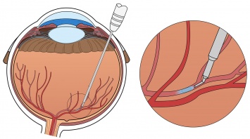 Робот-хирург впервые помог вылечить окклюзию сетчатки