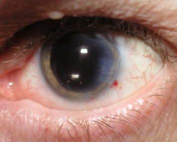 Ученые нашли способ лечить катаракту без операционного вмешательства