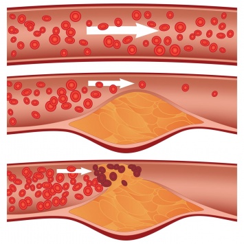 5 признаков забитых артерий