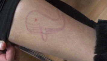 "Синий кит" на Сумщине: около 30 учеников имеют на теле характерные порезы