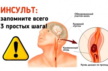 Инсульт: Запомните 3 простых шага, чтобы спасти жизнь себе или близким!