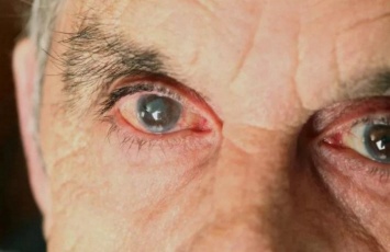 Российские ученые узнали, как можно остановить развитие катаракты