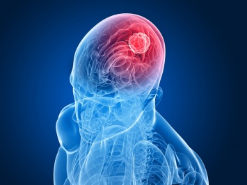 10 симптомов, причиной которых может быть опухоль мозга