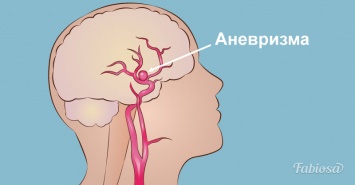 Аневризма cосудов головного мозга: все, что нужно знать, чтобы предотвратить беду
