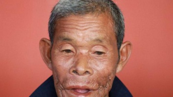Мужчина 30 лет прожил с огромной опухолью во рту (фото)
