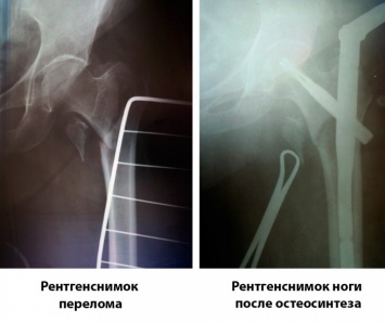 Современное лечение переломов в Запорожской областной больнице: без гипса, постельного режима и возрастных противопоказаний