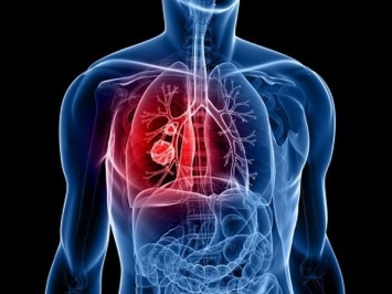 Обнаружен новый механизм, способствующий развитию рака легких