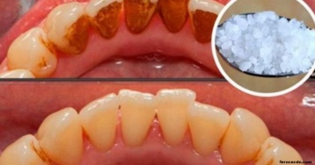 Вот как избавиться от зубного камня без помощи стоматолога