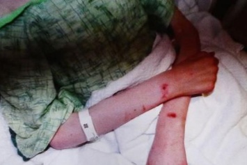 Кровавые раны на ногах и руках: мать заморила голодом падчерицу