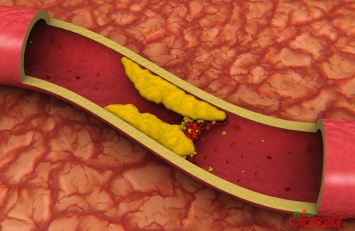 Ученые нашли лучшее «лекарство» от повышенного холестерина