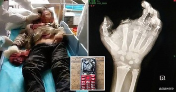 12-летний мальчик потерял палец и почти ослеп, когда его телефон взорвался