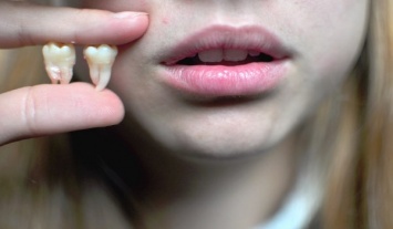 Медики назвали главные мифы по поводу зубов мудрости