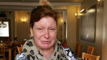 "Я не улыбаюсь 34 года": женщина страдает из-за ошибки врачей (фото)