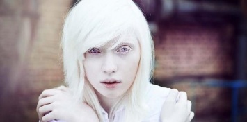 Сегодня Международный день распространения информации об альбинизме