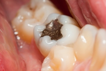 Новые МРТ-аппараты могут выдавливать ртутит из зубных амальгам
