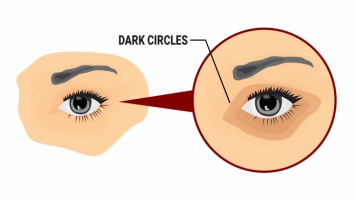 5 простых способов удаления темных кругов под глазами естественным способом