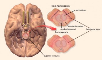 Найден новый метод ранней диагностики болезни Паркинсона
