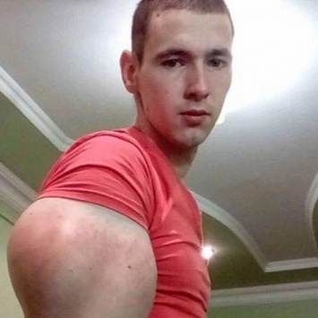 «Смотреть противно!»: Кирилл Терешин из-за синтоловых «рук-базук» страдает от прыщей на лице