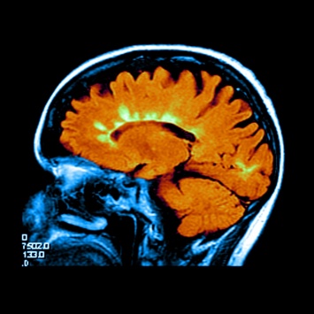 Лекарство от рассеянного склероза уменьшило атрофию мозга, но вызвало головные боли