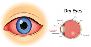 4 простых способа природного лечения сухости глаз