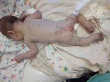 Найденный в Первомайске новорожденный в крайне тяжелом состоянии