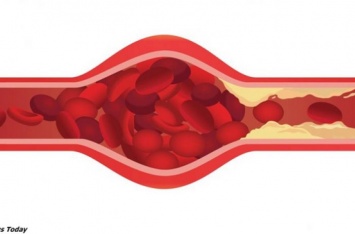 5 тревожных признаков, что ваши артерии уже забиты бляшками