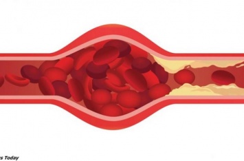 Как очистить сосуды, чтоб не бояться инсульта