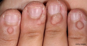 5 ужасных вещей, которые могут случиться с теми, кто грызет ногти