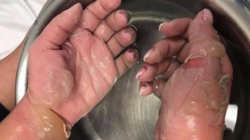 "Адский" маникюр: девушка осталась без кожи после снятия акриловых ногтей (фото)