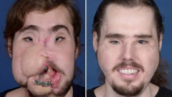 Американец удивил весь мир пересаженным лицом: фото до и после